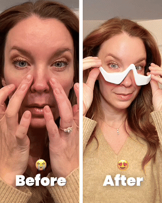 Tired of Looking Tired? Here’s How to Fix Under-Eye Bags Without Surgery