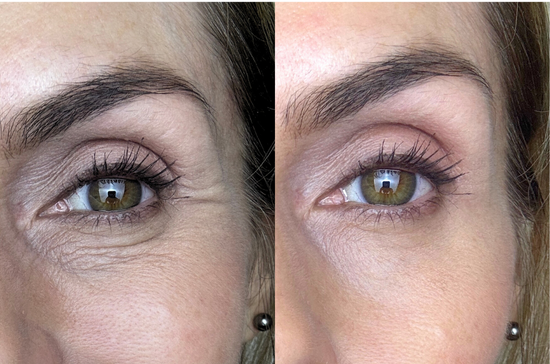 Before and After results of red light therapy