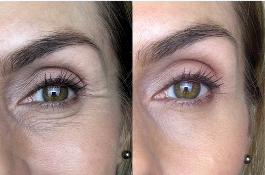 Before and After results of red light therapy