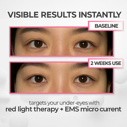 SolaraEyes Under-Eye Red Light Therapy