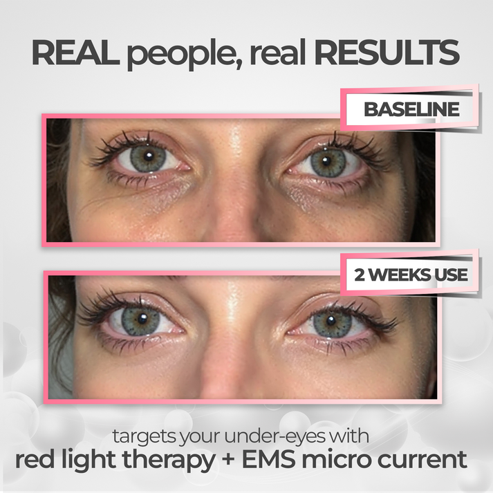 before and after results using red light eye mask for wrinkles