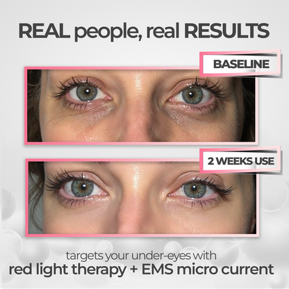 before and after results using red light eye mask for wrinkles