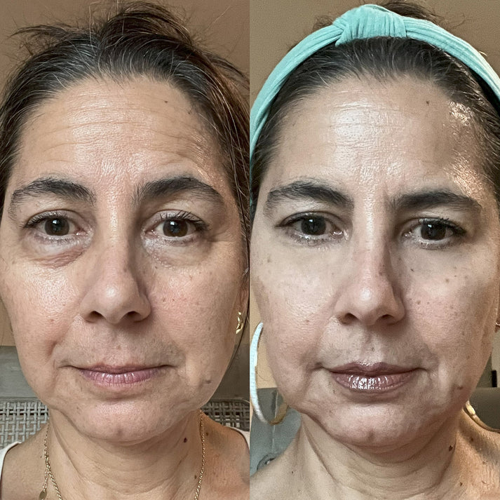 visible reduction in fine lines and dark circles with LED therapy