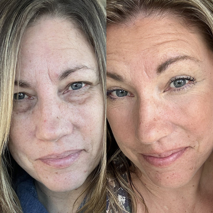 Solara Glow results after 30 days of red light eye treatment